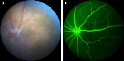 Carbon Dots Fabrication: Ocular Imaging and Therapeutic Potential